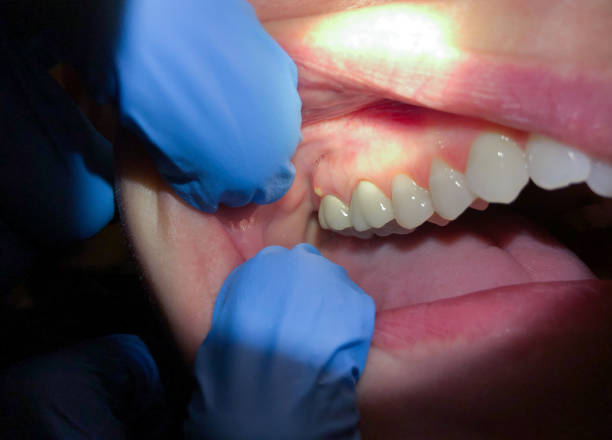 Best Emergency Treatment for Oral Infections in Sandia Heights, NM